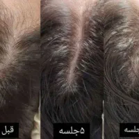 کلینیک تخصصی  خدمات زیبایی(ژل و بوتاکس ) با تخفیف|خدمات آرایشگری و زیبایی|کاشان, فین کوچک|دیوار