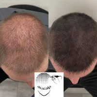 میکرواسکالپ/اسکالپ/پرپشتی مو تضمینی(آموزش و اجرا)
