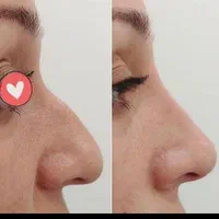 فیلر بینی  برطرف کردن قوز بینی  بینی شکسته و کج|خدمات آرایشگری و زیبایی|خرم‌آباد, |دیوار