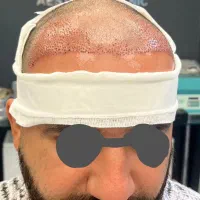 نیازمند مدل‌ رایگان کاشت مو