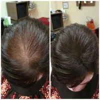 رفع ریزش مو کاملاگیاهی|آرایشی، بهداشتی، درمانی|احمدی, |دیوار