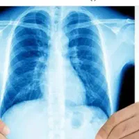 مشاوره طب سنتی برای مشکلات تنفسی