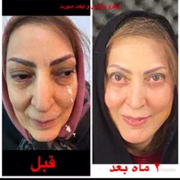 بلفاروپلاستی،لیفت صورت ابرو،اتوپلاستی،لیزر مو تاتو|خدمات آرایشگری و زیبایی|تبریز, |دیوار