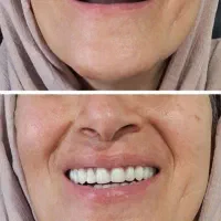 دندانسازی متحرک و ثابت|آرایشی، بهداشتی، درمانی|فردیس, شهرک ناز|دیوار