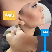 تخفیف تزریق ژل و بوتاکس برای خانم ها و آقایون|خدمات آرایشگری و زیبایی|شاهینشهر, خانه کارگر|دیوار