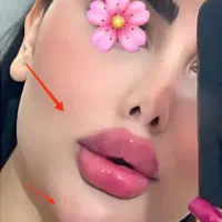 جشنواره50%  ژل بوتاکس آنزیم مزو برداشتن خال زگیل