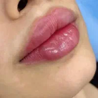 خدمات ژل و بوتاکس با بهترین مواد