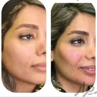 تزریق، فیلر ، بوتاکس، ژل ، آنزیم|خدمات آرایشگری و زیبایی|شیراز, سینما سعدی|دیوار