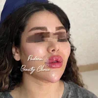 فیلر ژل بوتاکس