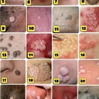 درمان منگوله‌های پوستی زگیل تبخال