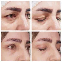 مرکز جراحی زیبایی پلک (بلفاروپلاستی)
