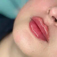 تخفیف جمعه مزوژل ها،فول فیس،در کلینیک
