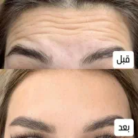 تزریق ژل .بوتاکس .انزیم بینی .مزوژل جوانساز|خدمات آرایشگری و زیبایی|جهرم, |دیوار