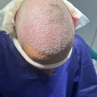 کاشت مو کوهدشت