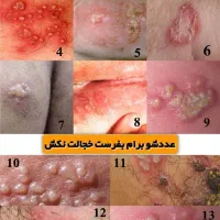 درمان ریشه ای تبخال و زگیل تناسلی با گیاهان دارویی|آرایشی، بهداشتی، درمانی|مشهد, سجاد شهر|دیوار