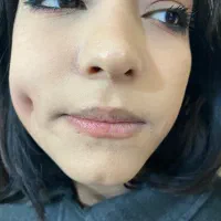 چال گونه‌ و چال لپ