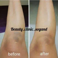 ریموو تتو و رفع تیرگی با Q-Switch