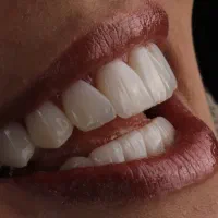 دندان پزشکی/لمینیت/ارتودنسی/کامپوزیت/ایمپلنت