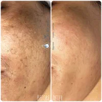 رفع لک ها و روشن سازی پوست|خدمات آرایشگری و زیبایی|اصفهان, مفتح|دیوار