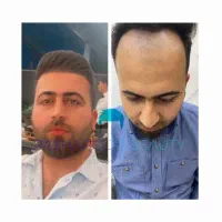 کاشت مو و ابرو و ریش با تراکم