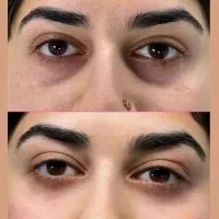 تخفیف ویژه ژل لب گونه کانتورینگ بوتاکس پی آر پی