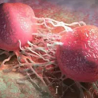 بهبود پروستات مجاری ادراری با نتیجه قطعی و تضمینی