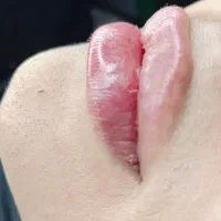 فیلر لب|خدمات آرایشگری و زیبایی|مشهد, رده|دیوار