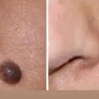 برداشتن خال و تزریق ژل و بوتاکس بانوان