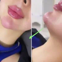 جشنواره50% ژل بوتاکس آنزیم خال مزو زگیل لابیا زگیل|خدمات آرایشگری و زیبایی|کرمانشاه, |دیوار