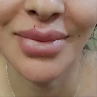 تزریق ژل بوتاکس مزو نخ جوانساز باقیمت مناسب درمنزل