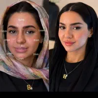 تزریق ژل وبوتاکس ۷۹۰. فول فیس ۴۵۰۰توسط پزشک مجرب