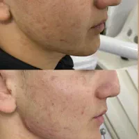 تزریق فیلر و بوتاکس اقساط توسط پزشک در مطب|خدمات آرایشگری و زیبایی|خرمشهر, |دیوار