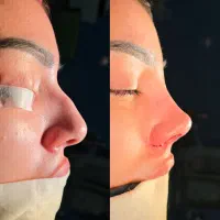 جراحی بینی با پیشرفته ترین تکنیک در خوی