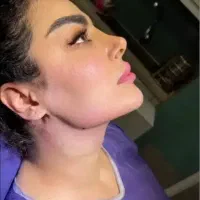 بلفاروپلاستی ساکشن غبغب بوکال لیفت ابرو تیپ پلاستی