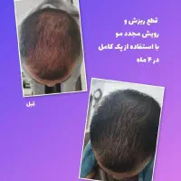 پکیج ریزش و رویش مجدد