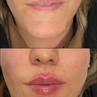 تخفیفات ویژه ژل و بوتاکس ورفع کک و مک ومزو وprp|خدمات زیبایی و سلامت|شیراز, مبعث|دیوار
