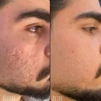معجزه پوست و مو پی ارپی و مزو ۵۰۰