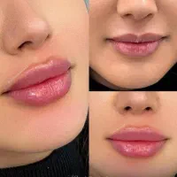 تزریق ژل بوتاکس لیفت مادلینگ و کانتورینگ عربی
