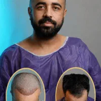 کاشت مو (مدل) 4 میلیون ظرفیت محدود