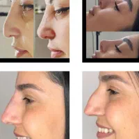 ژل بوتاکس آنزیم مزو بلفارو دایرکت