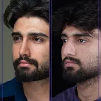 جراحی بینی با قیمت سال قبل+اقساط+مشاوره رایگان