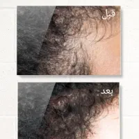 رفع مشکلات پوست و مو|آرایشی، بهداشتی، درمانی|بندر ترکمن, |دیوار