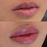 مدل برای تزریق ژل و بوتاکس زیر نظر پزشک