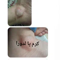 کرم ترک پای قوی لدورا ترمیم سریع ترک و خشکی|آرایشی، بهداشتی، درمانی|شاهرود, |دیوار