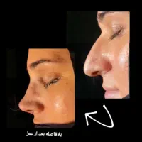 قسطی جراحی بینی و پیکرتراشی و لیفت صورت و ژل|خدمات آرایشگری و زیبایی|تبریز, |دیوار