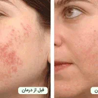 فروش دستگاه لیزر کیوسوئیچ پیکوشور|پزشکی|شیراز, پارک آزادی|دیوار
