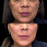 تزریق چربی جوانساز|خدمات آرایشگری و زیبایی|رفسنجان, |دیوار