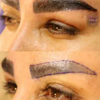 کاشت ابرو و مو با تیم متخصص