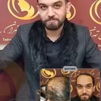 کاشت مو بصورت کاملاً تخصصی|خدمات آرایشگری و زیبایی|پاکدشت, پاکدشت (مامازند)|دیوار