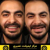 ایمپلنت دندان دیجیتالی و قیمتی استثنایی